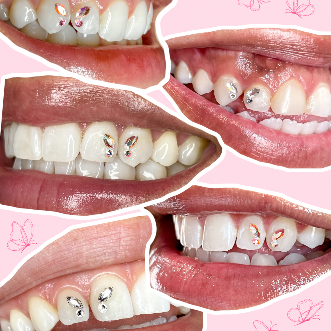 How to Make Butterfly Tooth Gems Last Longer